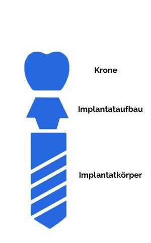 Aufbau eines Zahnimplantats